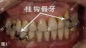 假牙有几种类型图片