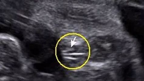 孕妇孕囊有长的有圆的是什么原因