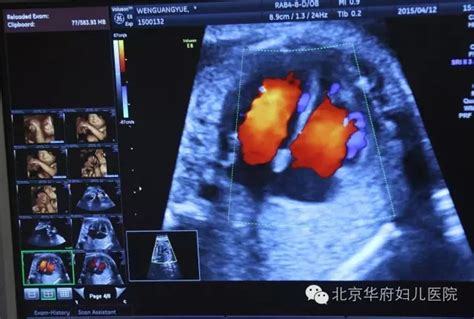 女婴心脏长在胸外！如何给胎儿一个健康的心脏