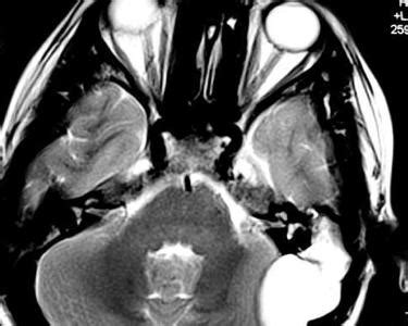 耻骨上肿瘤良性和恶性的区别