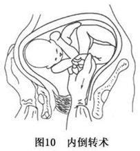 31周胎位右横位，没有绕颈，怎么办？