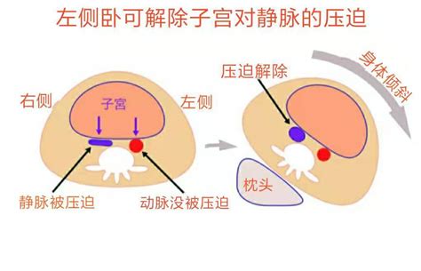 孕妇睡姿为什么要左侧卧位