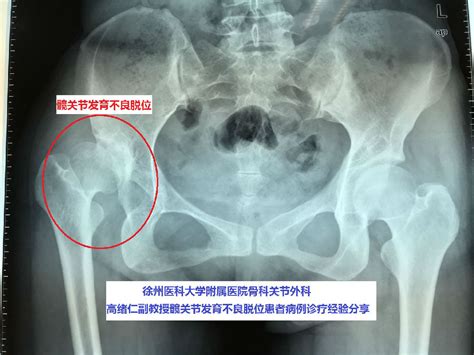 髋关节移位要治疗吗
