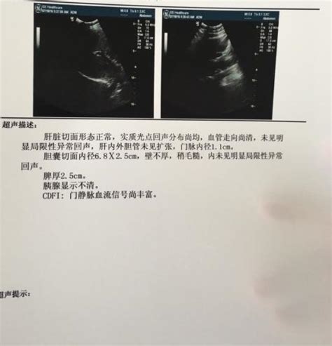 b超单上的图像怎么看的