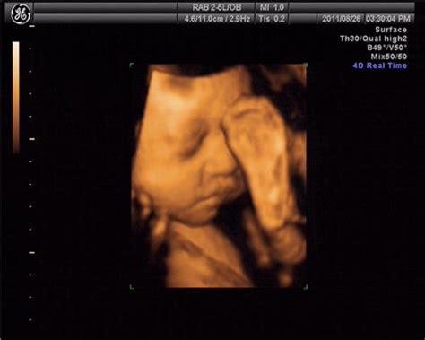 怀孕23周胎儿彩超图
