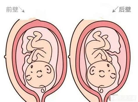 胎儿在胎盘的前壁和后壁有区别吗