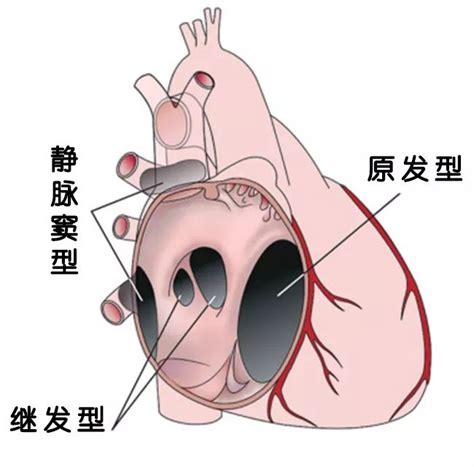 心室缺损手术最佳年龄