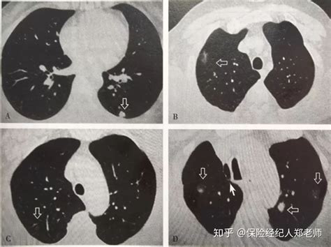 肺结节吃什么可以散结