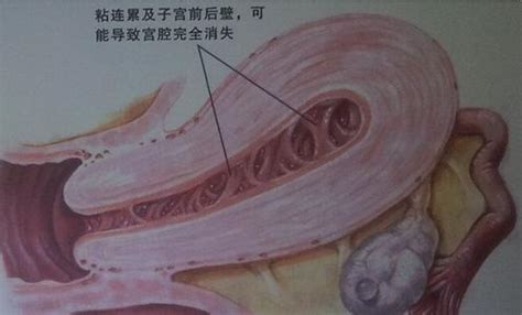 孕期怎样预防胎盘早剥