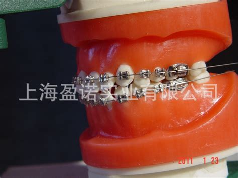 牙齿正畸有什么副作用吗