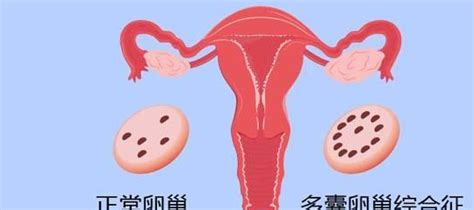 多囊卵巢对试管婴儿有影响吗