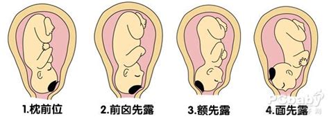 胎儿臀位是什么意思