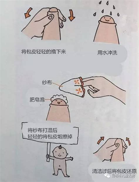 男性必须要割包皮吗?