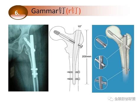 老年人股骨颈骨折手术后护理