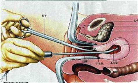 刮宫后右腹隐隐作痛