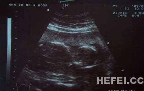 胎儿脐带绕颈孕妈需要注意些什么?