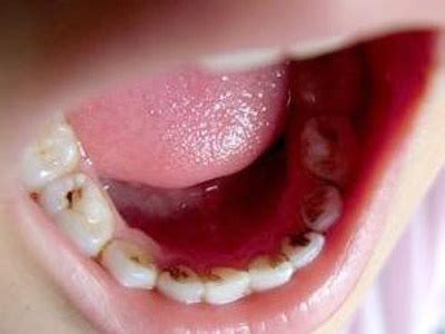 嘴巴里有金属假牙能做磁共振吗