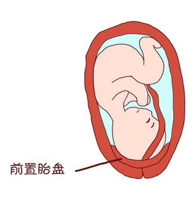 14周胎盘低置出血胎儿能保住吗