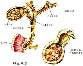 胆结石打孔好还是开刀好