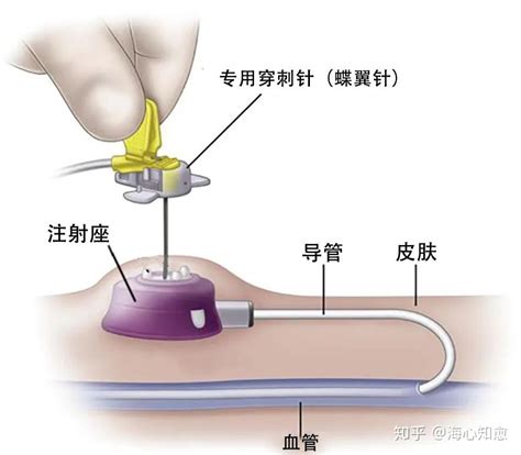 催经针有副作用吗