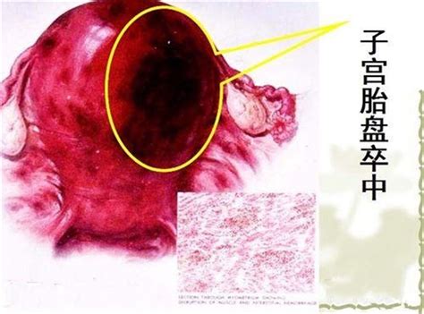 孕晚期胎盘早剥有什么症状