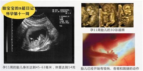 怀孕第11周胎儿发育情况