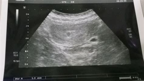 照了X光几天后发现怀孕了对胎儿有影响吗