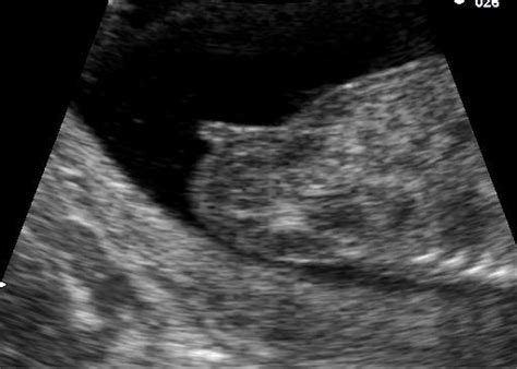 孕妇判断胎儿性别方法大全