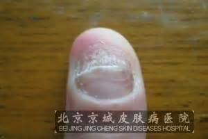 指甲花能治灰指甲吗