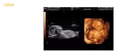 胎儿心脏彩超能检查出什么病