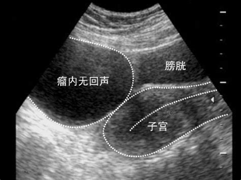 卵黄囊瘤恶性致死率