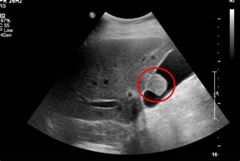 无胆囊人的寿命