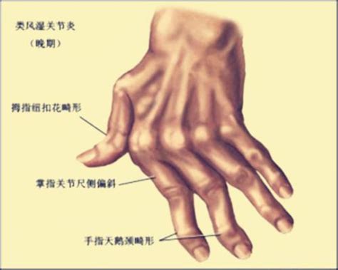 手指畸形怎么跟女生说