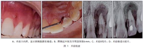 年轻恒牙根管孔闭合图片