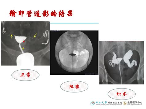 女性如何检查输卵管堵塞