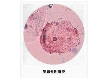 念珠菌性阴炎和细菌性阴炎的区别