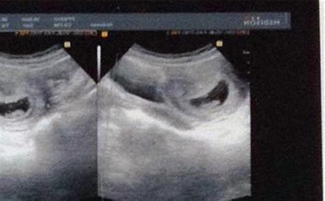 双胞胎10周的b超图