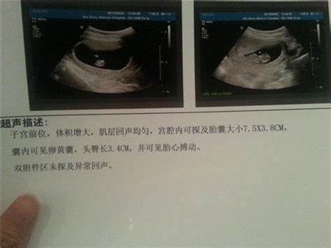 怀孕12周彩超图