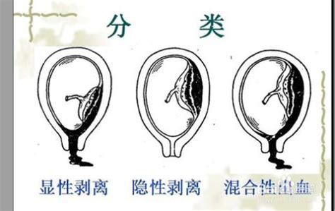 孕期前置胎盘有什么症状