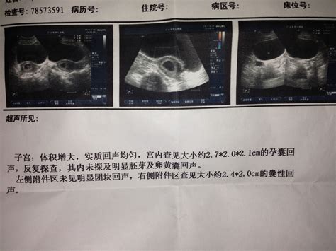 怀孕一个月检查b超图片