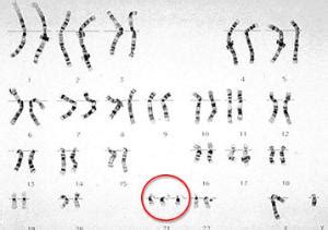 唐氏综合征是什么原因造成的