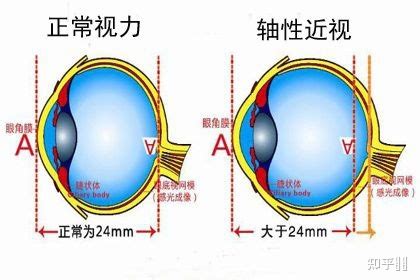 一只眼睛近视能恢复吗