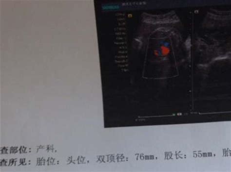 四维彩超显示胎儿正常