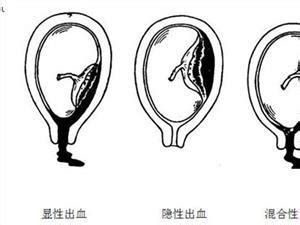 胎盘低是什么原因造成的有没有危险