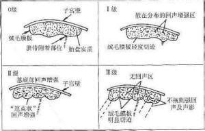 胎盘成熟度与预产期有关系吗