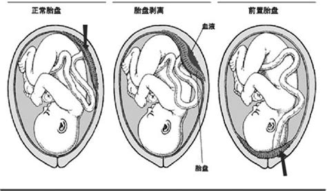 37周胎盘厚5.5