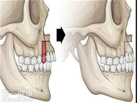 牙槽突裂植骨术三十岁能做吗