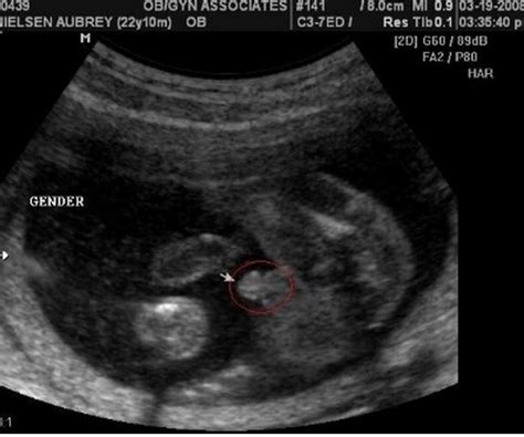 孕9周多的胎儿的真实图
