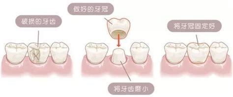 种牙二期比一期痛