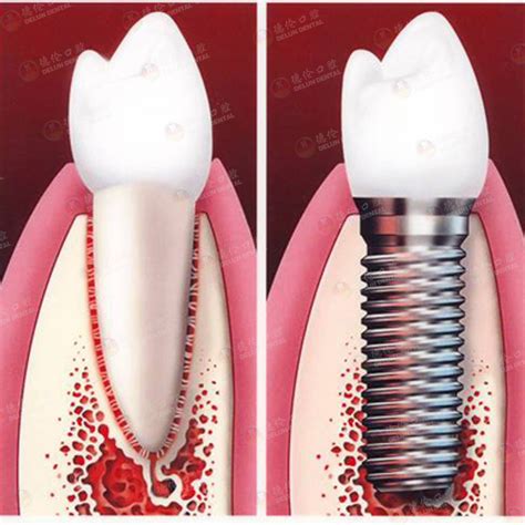 口腔种植牙广告图片